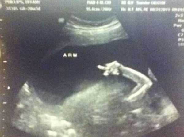 中指立ててる…？妊娠時の超音波検査で、意外なポーズを取っている胎児たちが可愛い