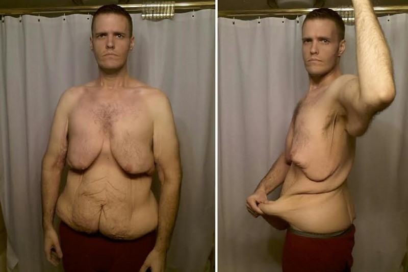 一気に177キロ痩せた男性、皮膚が余り過ぎてクラウドファンドで手術代を募る